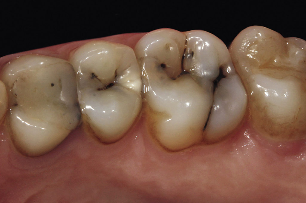 Рис. 3. Сегмент зубного ряда верхней челюсти для более детального анализа микроэстетики.