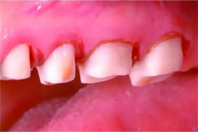 Interim restoration cementation with polycarboxylate cement
