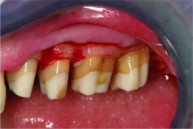 Ostectomy, roots reshaping, osteoplasty