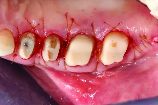 Flap replacing, suturing