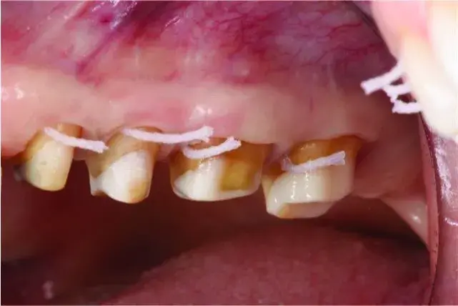 Ideal gingival health and adequate ferrule