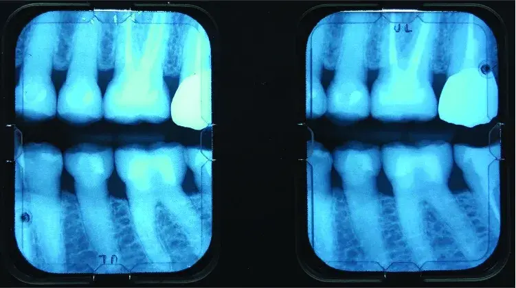 X-ray, radiographic image