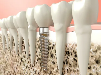 Osseointegration and factors influencing it