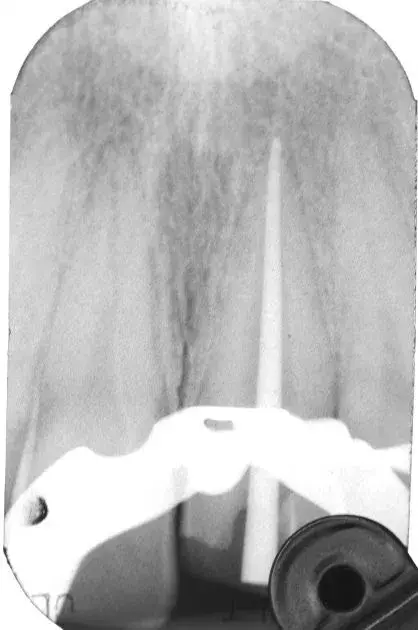 Внутриротовой рентгеновский снимок