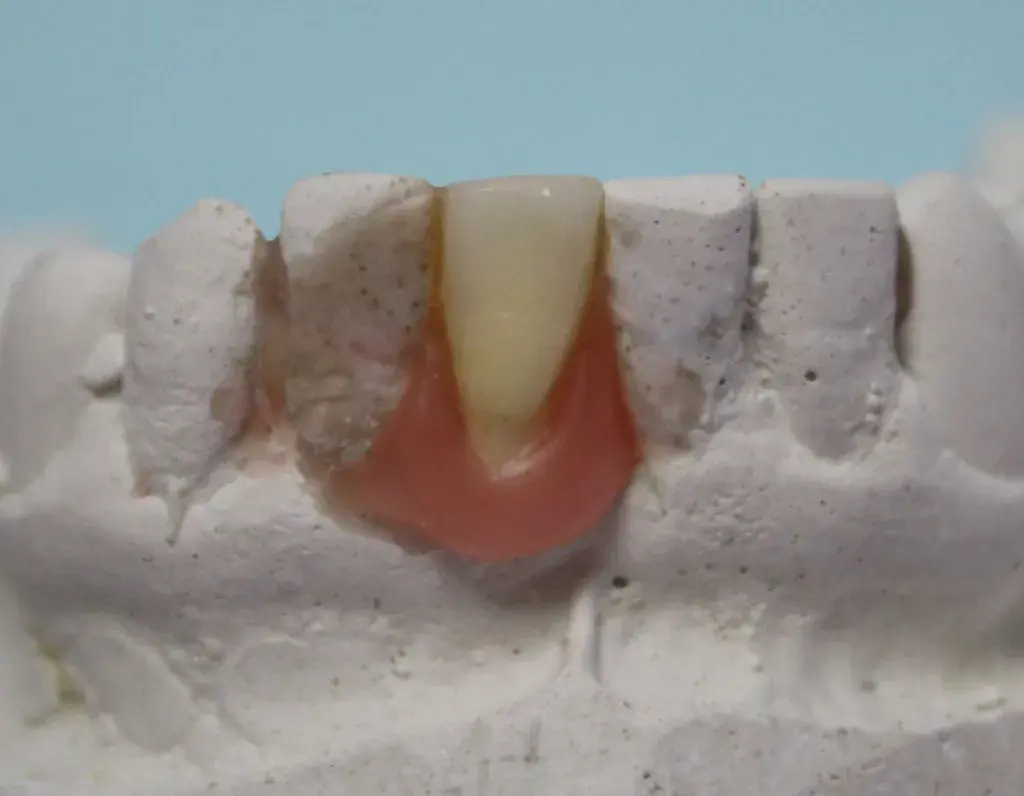 Непосредственный протез из удаленного зуба