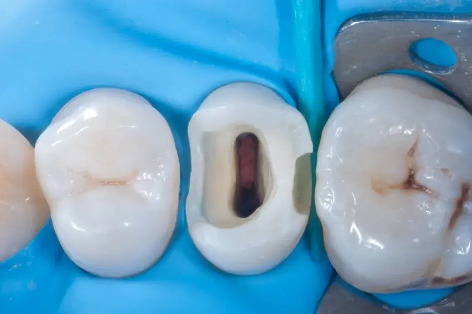 Состояние зуба после эндодонтического лечения