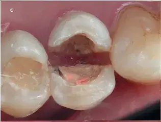 Клинический случай, продольный перелом зуба