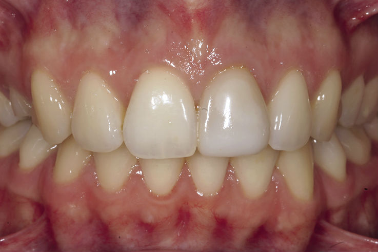 Рис. 5. Фотография зубных рядов при полном смыкании в привычной окклюзии.