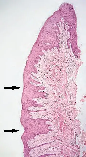 Бугристая поверхность микроскопически - это десневые углубления (стрелки на рисунке)
