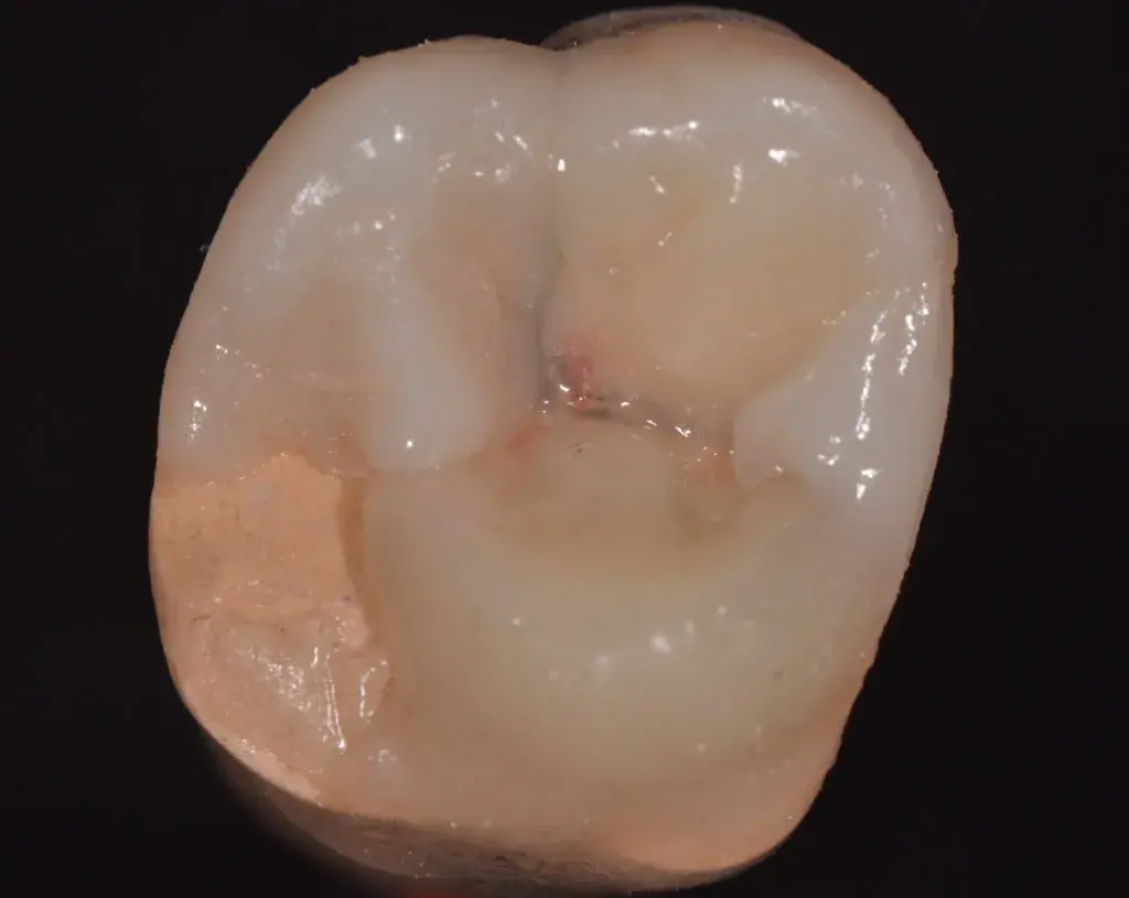 Мезиально-щечный бугор 16 зуба