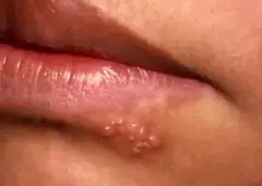 Клиника герпеса на губах