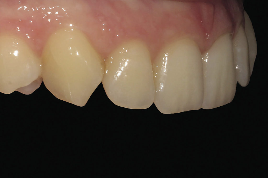 Рис. 5а. Снимок фронтальной группы зубов под углом 45 градусов. Вид справа.