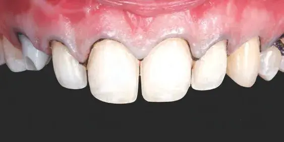 Minimally invasive tooth preparation