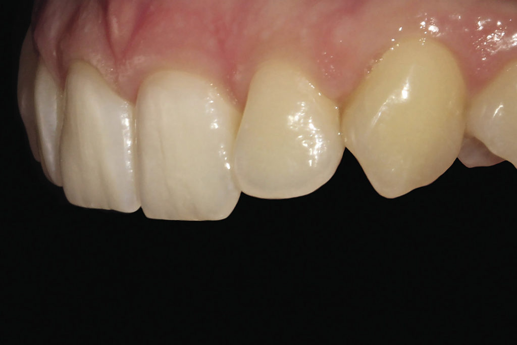 Рис. 5б. Снимок фронтальной группы зубов под углом 45 градусов. Вид слева.