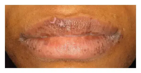 lips hyperpigmentation