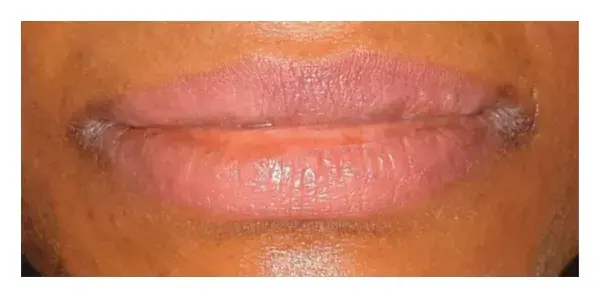 lips hyperpigmentation