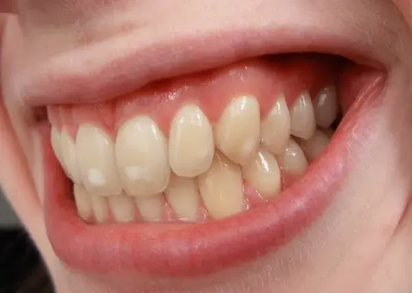 Качество эмали постоянных зубов зависит от состояния их временных предшественников