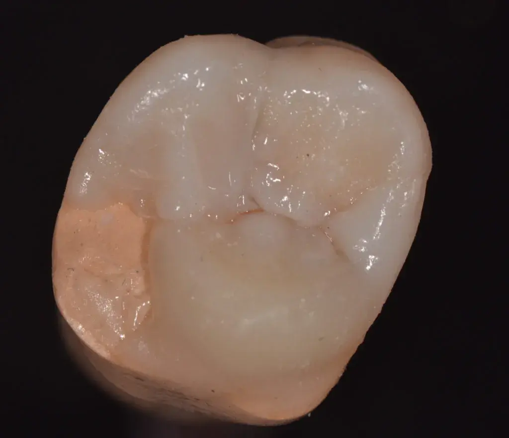 Мезиальный эмалевый валик 16 зуба