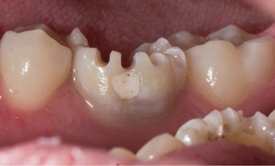 preparirovanie-zuba
