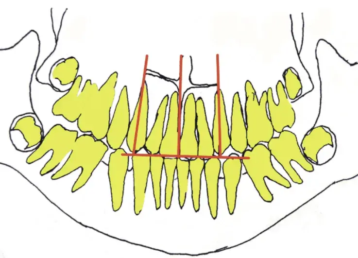 Контуры, скопированные с ортопантомограмм челюстей, полученных в динамике: 12 лет 1 месяц