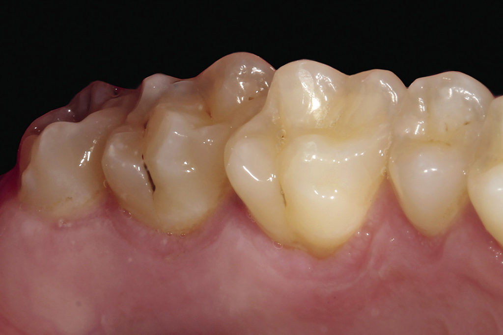 Рис. 6. Фотография небной поверхности боковой группы зубов.