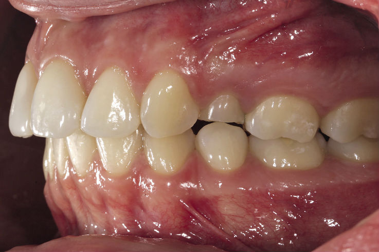 Рис. 6б. Фотография зубных рядов при полном смыкании в привычной окклюзии. Вид сбоку. Справа.