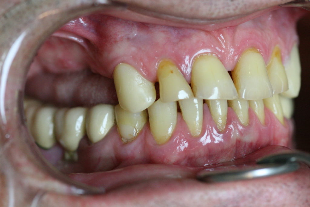 боковые зубы слева