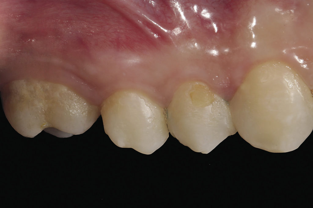 Рис. 7а. Фотография щечной поверхности боковой группы зубов.