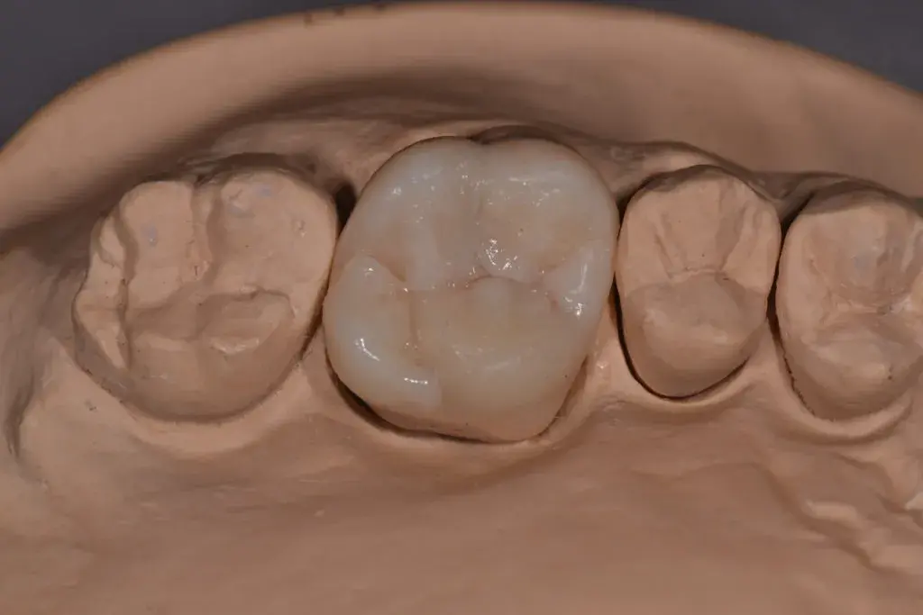 16 зуб в зубном ряду