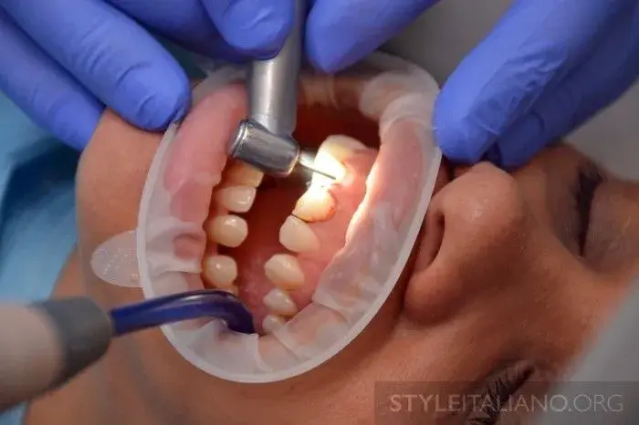 Подготовка зубов под виниры