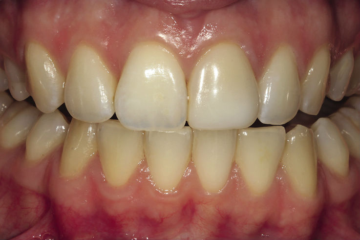 Рис. 8. Фотография фронтального отдела зубов. Резцы край в край.