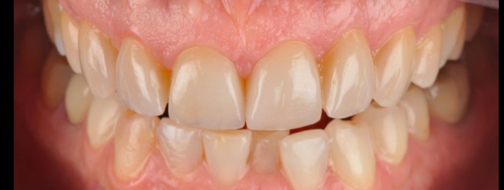 патологическая стираемость зубов фото