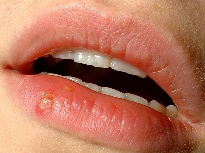 Афты - болезненные язвы во рту: причины и лечение