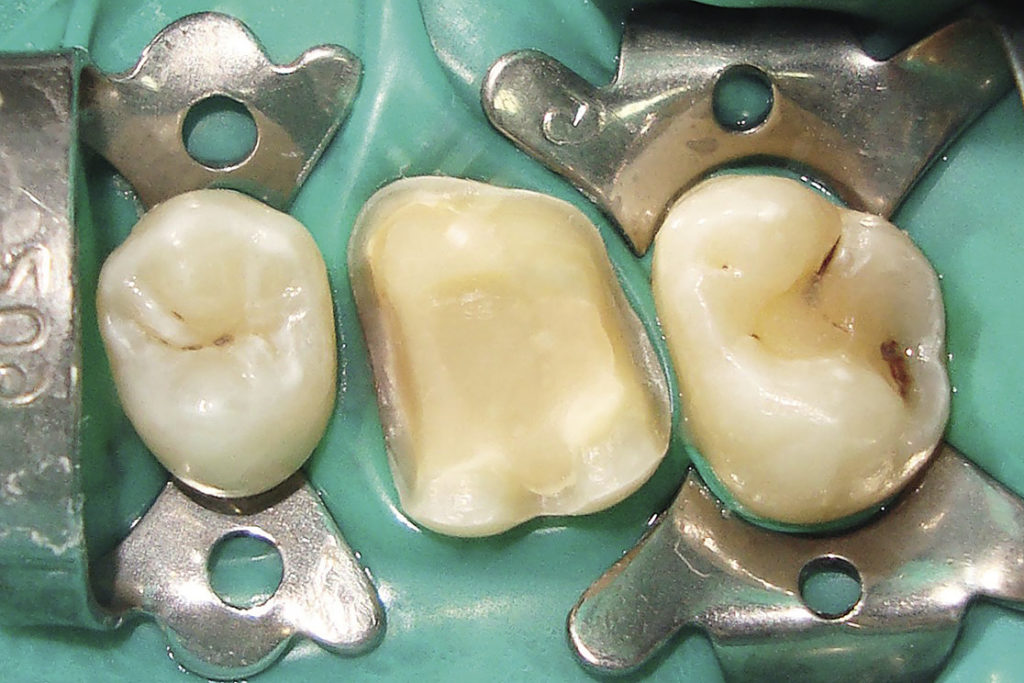Рис. 9. Фотография культи отпрепарированного зуба перед фиксацией ортопедической конструкции.