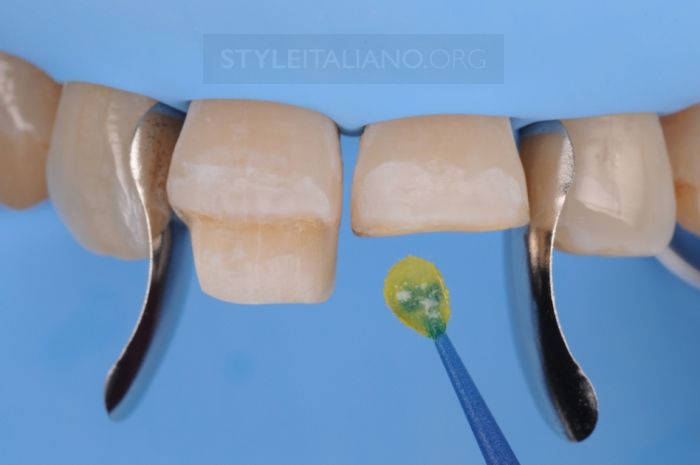 Адгезивная обработка зуба