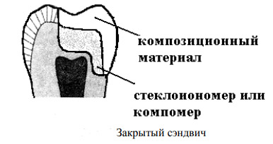 Полость закрывать. Сэндвич техника пломбирования. Закрытая сэндвич техника пломбирования. Сэндвич техника пломбирования кариозных полостей. Открытая сэндвич техника в стоматологии.