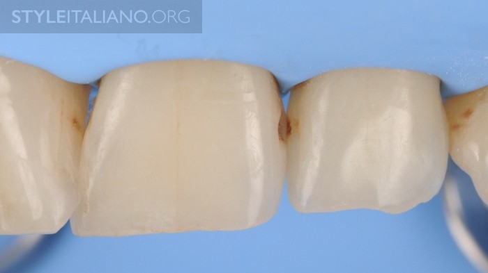 Кариес между зубов