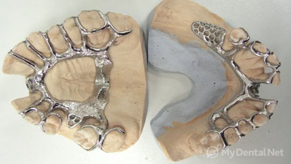 Кобальт хромовый сплав в стоматологии для каркаса