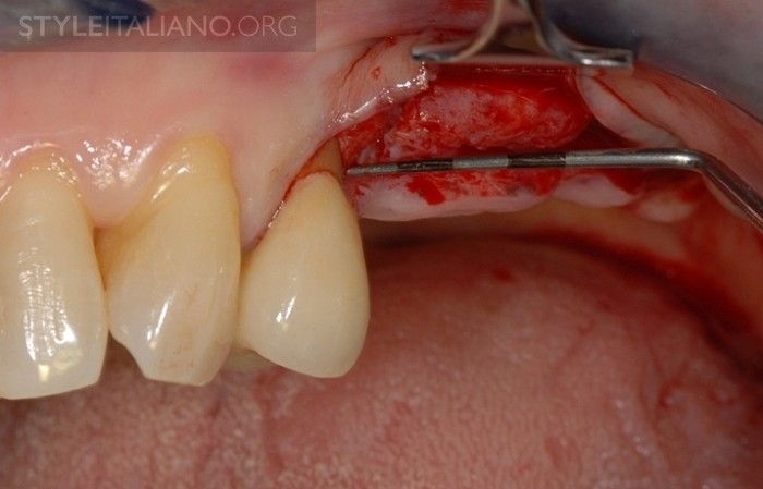 Имплантами Зубов