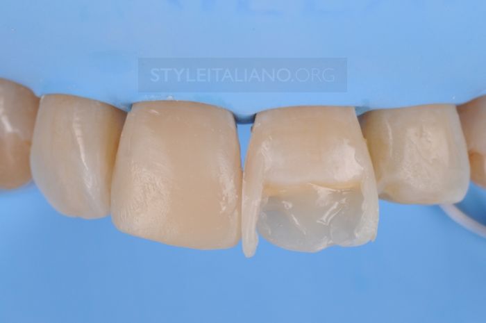 Реставрация переднего зуба