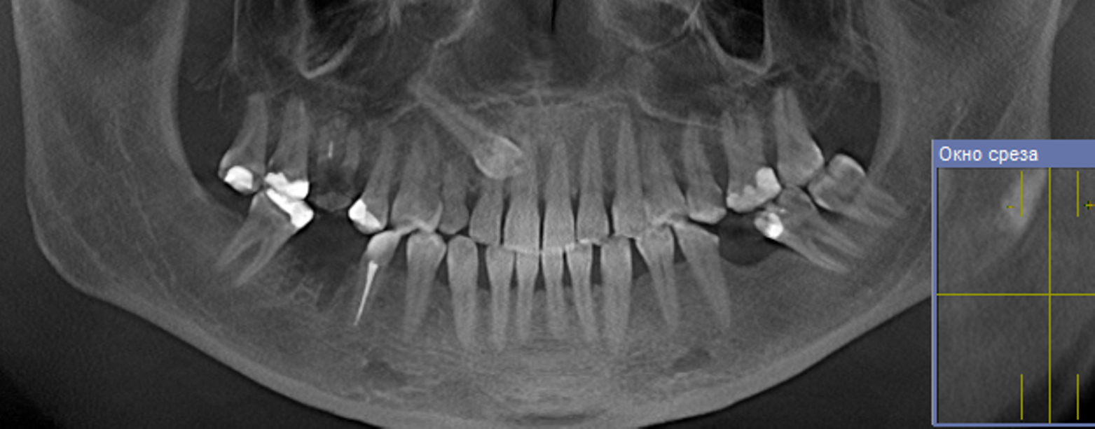 Ретенирование зуба. Ретинированный зуб мудрости рентген. Ретинированный зуб на верхней челюсти. Ретенированный клык рентген. Пародонтоз ортопантомография.