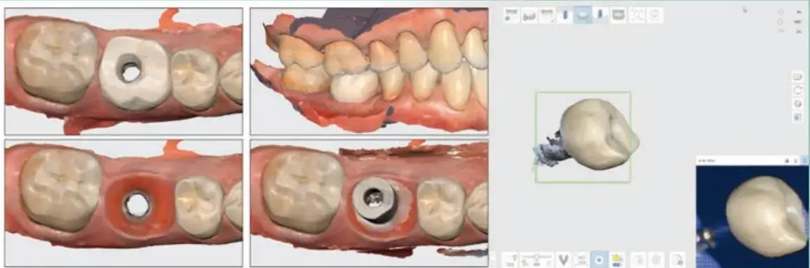 Escaneado intraoral