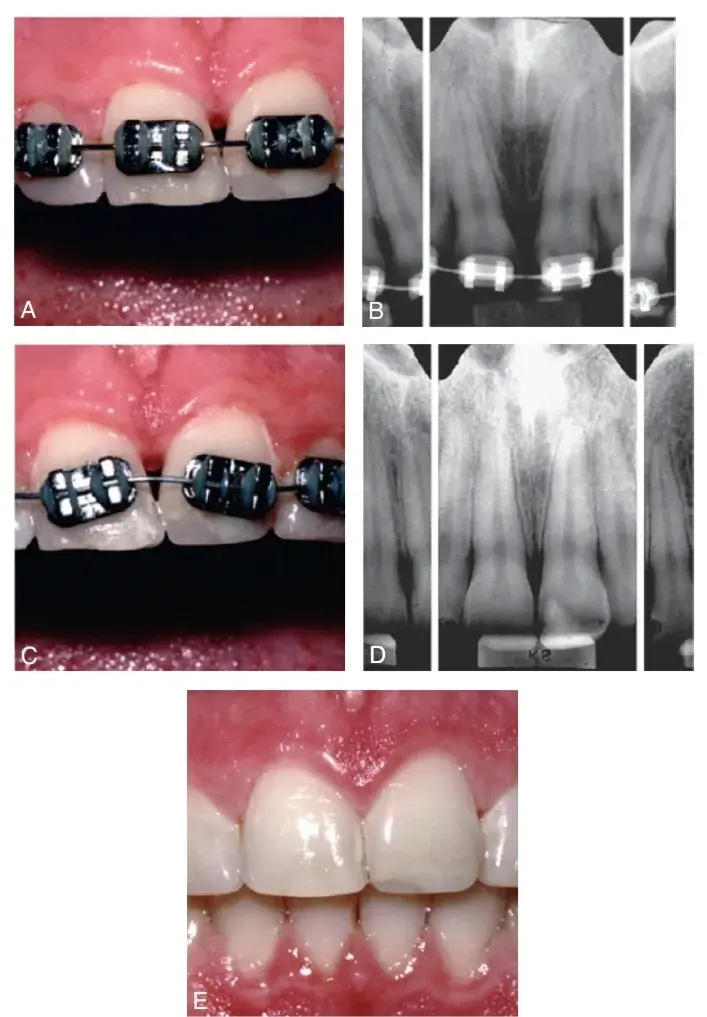 Orthodontic root reposition