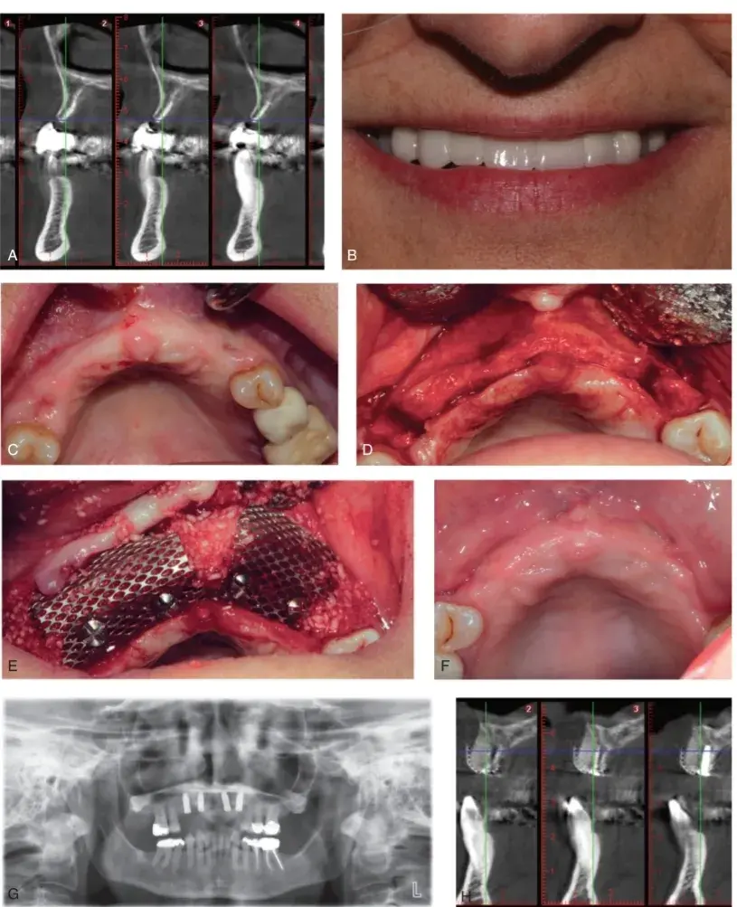 GBR, guided bone regeneration with titanium mesh