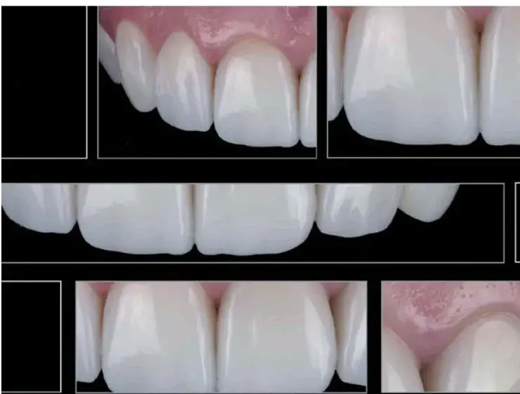 Direct composite restorations