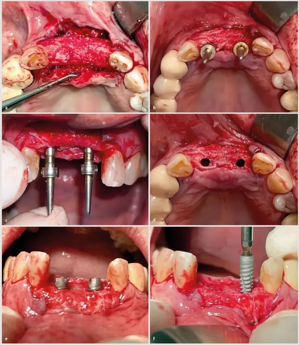 Colocación de los implantes