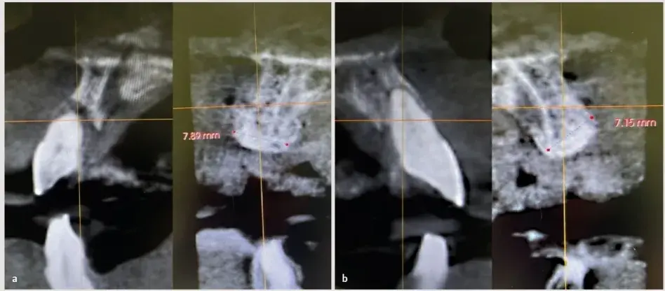 CBCT de la regeneración ósea guiada