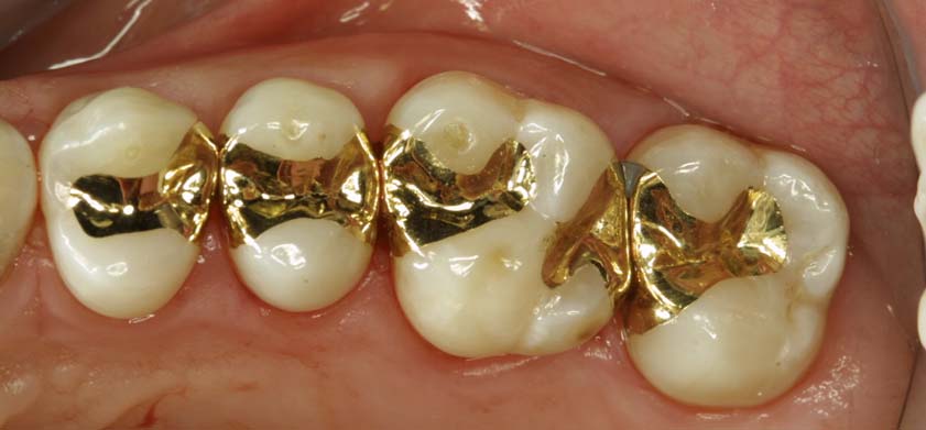 Сплав золота в стоматологии ортопедической