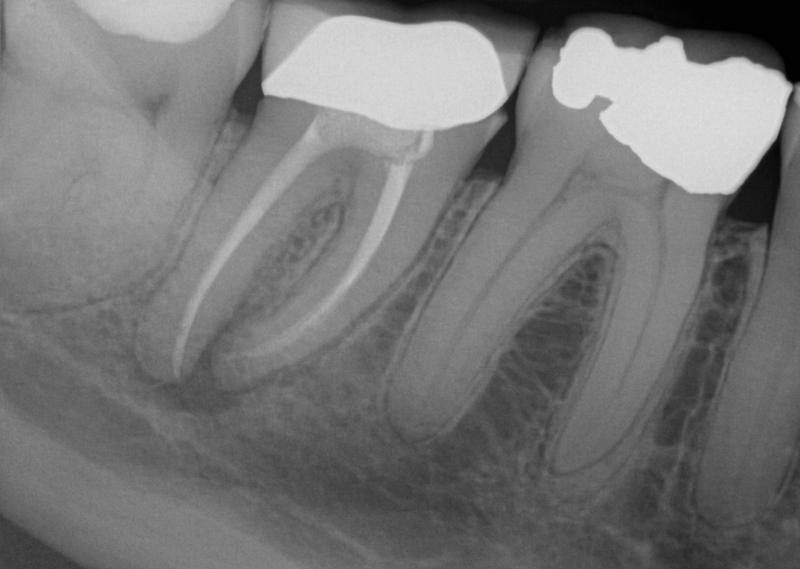 Лечение тройничного нерва после удаления зуба