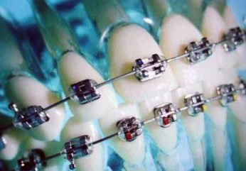 Анализ мягких тканей при ортодонтическом лечении